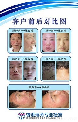 【香港瑤芳9點(diǎn)9元祛痘團(tuán)購(gòu)】_泉州國(guó)貿(mào)商城香港瑤芳專業(yè)祛痘團(tuán)購(gòu)10元_糯米麗人團(tuán)購(gòu)